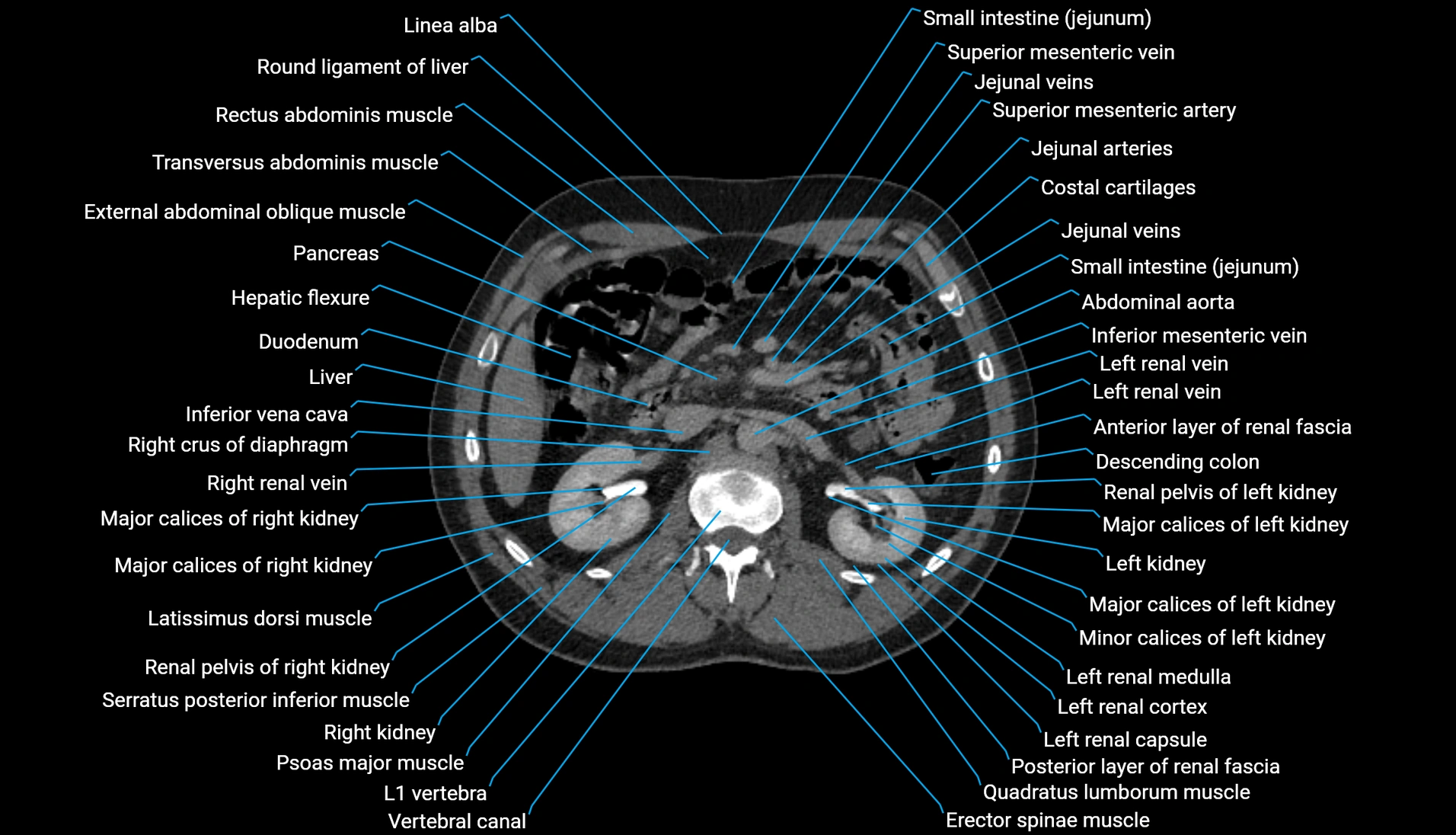 CT urogram axial cross sectional anatomy  labelled radiology image-00102.webp